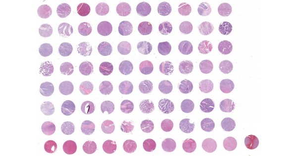 Ultimate Radiology Tnm Staging Of Hepatocellular Carcinoma Hcc My Xxx