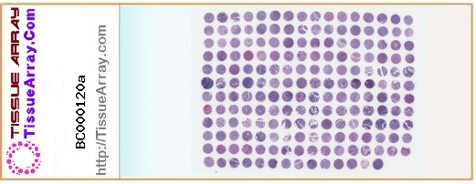 TissueArray.Com Tissue Array BC000120a