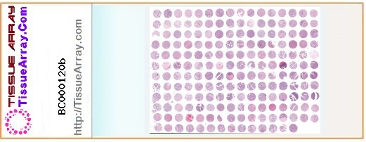 TissueArray.Com Tissue Array BC000120b