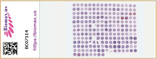 TissueArray.Com Tissue Array BC07114