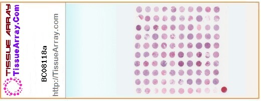 TissueArray.Com Tissue Array BC08118a