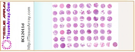 TissueArray.Com Tissue Array BC12011d