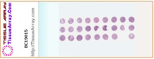 TissueArray.Com Tissue Array BC19015