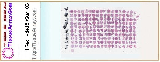 TissueArray.Com Tissue Array HRec-Ade180Sur-03