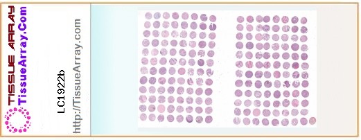 TissueArray.Com Tissue Array LC1922b