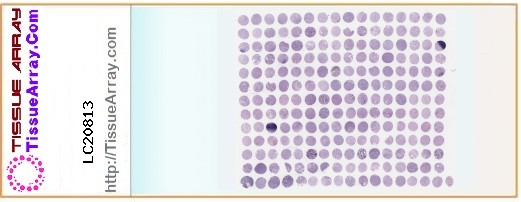 TissueArray.Com Tissue Array LC20813