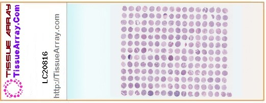 TissueArray.Com Tissue Array LC20816