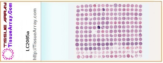 TissueArray.Com Tissue Array LC2085a