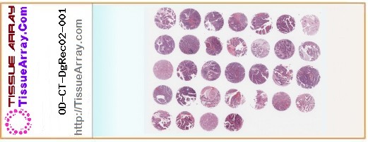 TissueArray.Com Tissue Array OD-CT-DgRec02-001