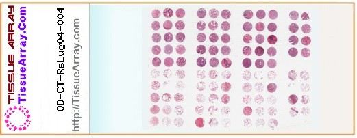 TissueArray.Com Tissue Array OD-CT-RsLug04-004