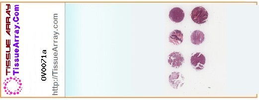 TissueArray.Com Tissue Array OV0071a