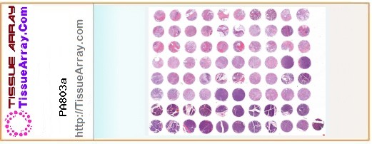 TissueArray.Com Tissue Array PA803a