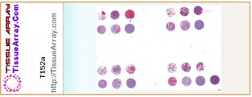 TissueArray.Com Tissue Array T152a